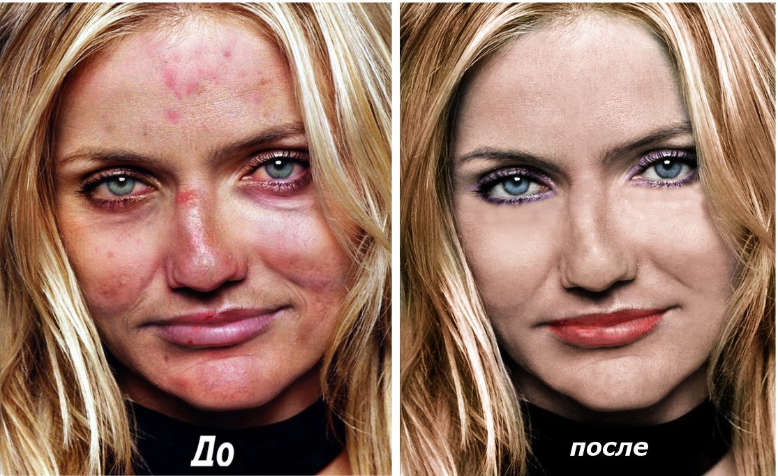 Устранение дефектов кожи на лице