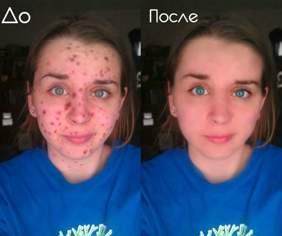 Дефект кожи