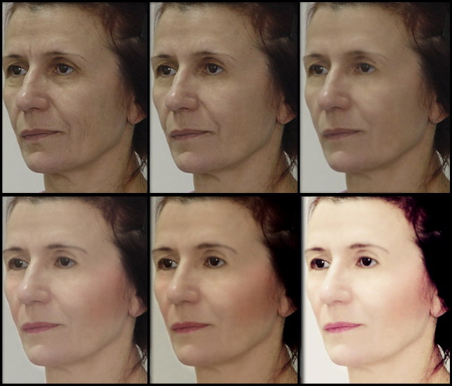 Омоложение