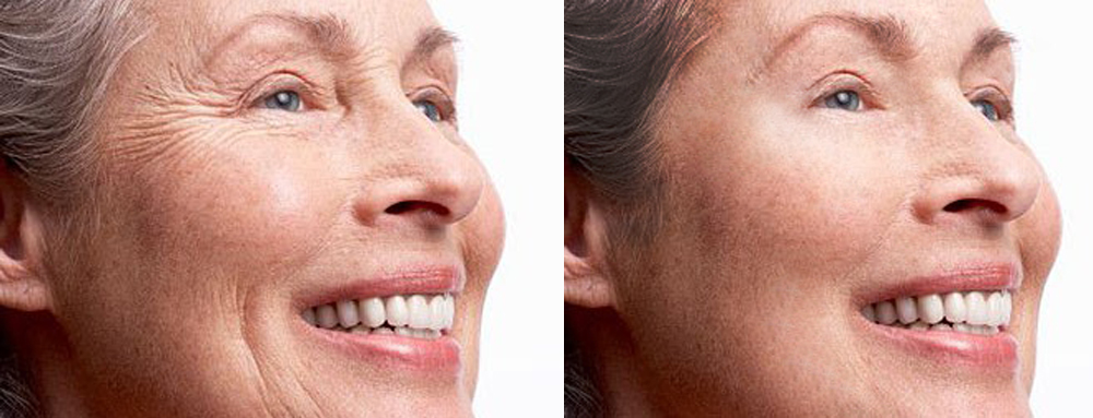 удаление морщин